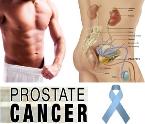 Obat kanker prostat alami